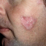 Discoid Lupus Erythematosus